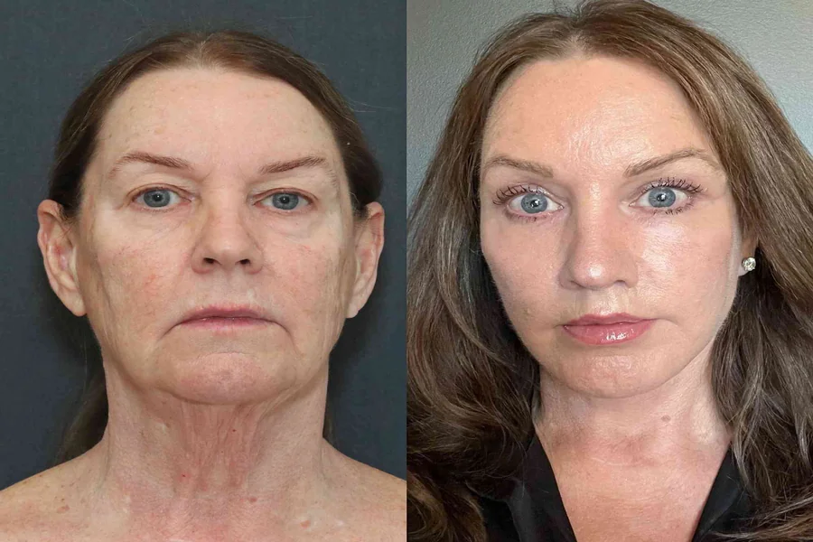 Facelift