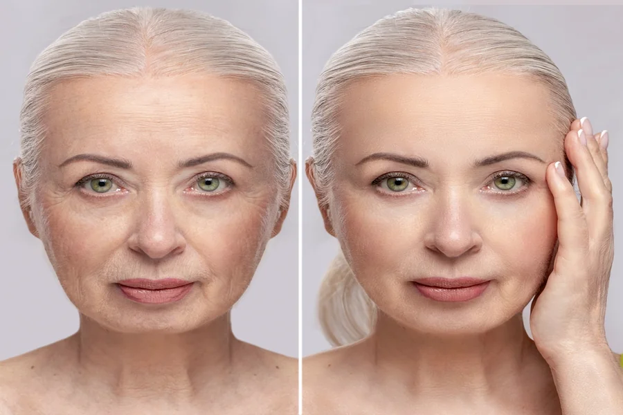 Facelift