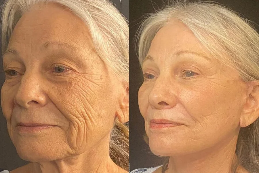Facelift