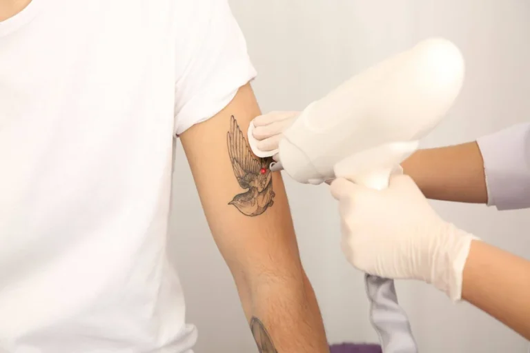 Tattoo Removal